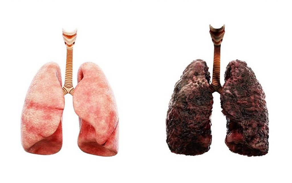 علائم مرگ در سرطان ریه چیست