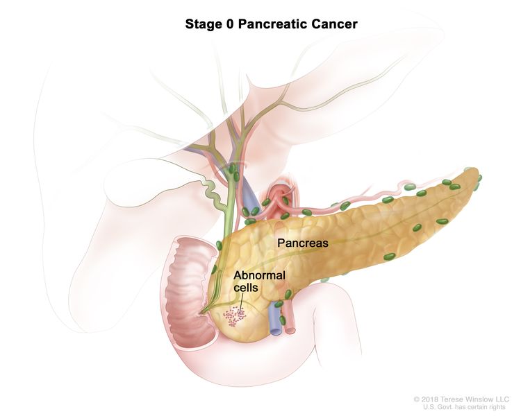 سرطان پانکراس چیست