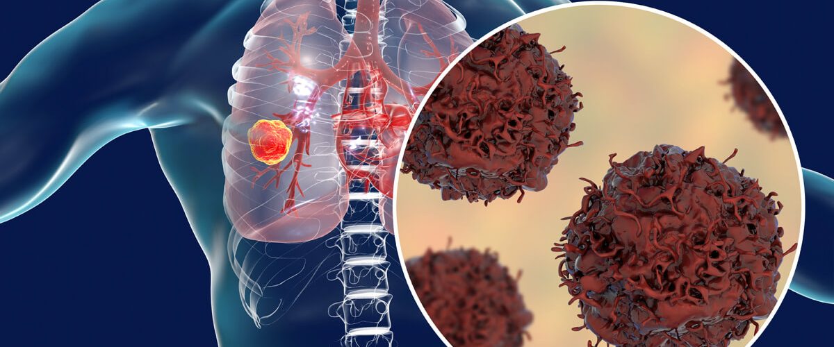 مهم ترین علائم و نکات درباره سرطان ریه 60+